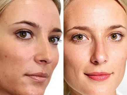 Mandula peeling, mi az, hogy mennyit eljárások, ár, mandulasav kozmetikumok (as) Mandula peeling, mi az, hogy mennyit eljárások, ár, mandulasav kozmetikumok