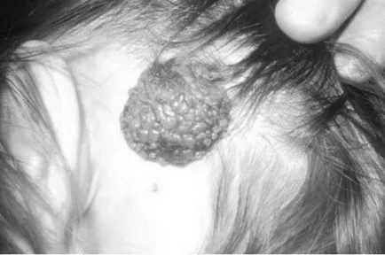 Nevus - okai, tünetei és kezelése