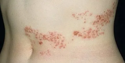 Herpes zoster tünetei és kezelése Felnőttek
