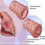 Szegény indul köpet köhögés felnőtt okokból (köhögés) Szegény indul köpet köhögés felnőttek okai