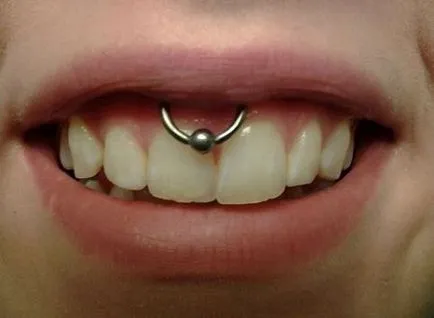 Piercing smiley - fotók, fájdalom, következmények, kockázatok, ár