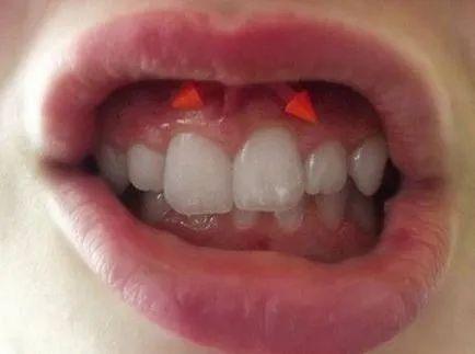 Piercing smiley - fotók, fájdalom, következmények, kockázatok, ár