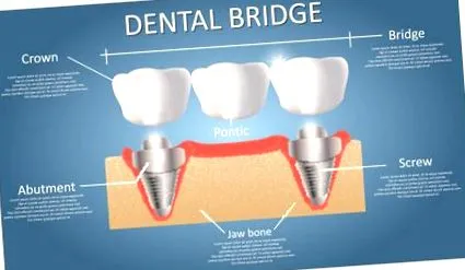 implantology
