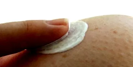 kezelés vulgaris
