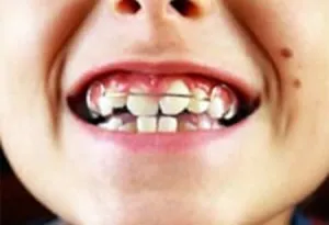 Következményei malocclusion (szövődmények) (hibás) Következményei malocclusion (szövődmények)