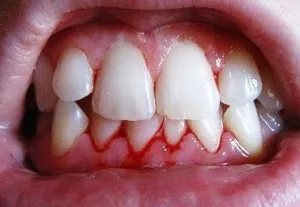 Következményei malocclusion felnőtteknél, mint gyermekeknél fenyeget hogy figyelmen kívül hagyja a problémát (malocclusion) Következményei malocclusion felnőtteknél, mint gyermekeknél fenyeget hogy figyelmen kívül hagyja a problémát