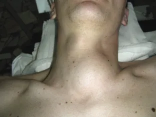 Duzzanat a nyakon balra, jobbra, elöl és hátul - választott orvos (balra) Duzzanat a nyakon balra, jobbra, elöl és hátul - választott orvos