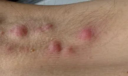 A dudor a hónalj fotó, okok, tünetek, kezelés, bőrbetegségek