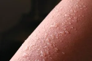 Leégés kezelésére és elsősegély ég a nap, valamint, mint kezelni leégés