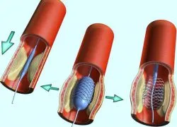 vascularis stent beültetést