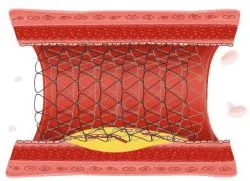 vascularis stent beültetést
