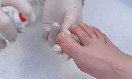 Lábgombásodás spray fajtái és jellemzői az alkalmazás (ok) Spray Lábgombásodás fajok jellemzői az alkalmazás