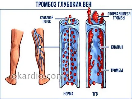 Thrombus láb tünetek és a kezelés okok, diagnosztikai módszerek (okok) A vérrög a lábában tünetek és a kezelés, okok, diagnosztikai módszerek