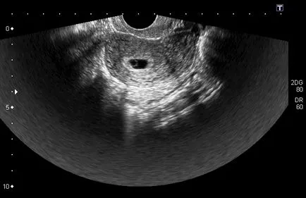 Ultrahang diagnosztika a terhesség kis távon (belső átmérője a petesejt) Ultrahang diagnosztika terhesség kis távon