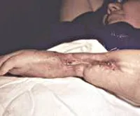 Krónikus osteomyelitis - okai, tünetei, diagnózis és kezelés (osteomyelitis) Krónikus osteomyelitis - okai, tünetei, diagnózisa és kezelése