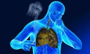 Krónikus bronchitis dohányos kezelése és tünetek hatékony kezelésére, mint a gyógyítás