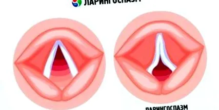 ларингугазму