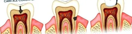 implantátum