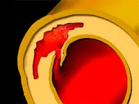 Atherosclerosis az aorta hogy