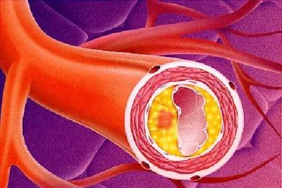 Atherosclerosis az aorta hogy