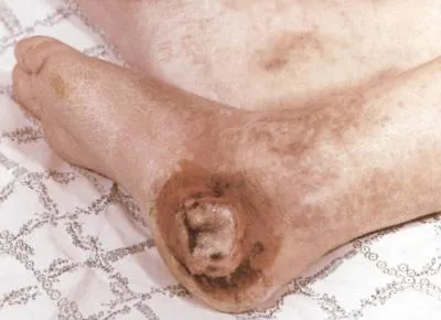 Atherosclerosis az aorta hogy
