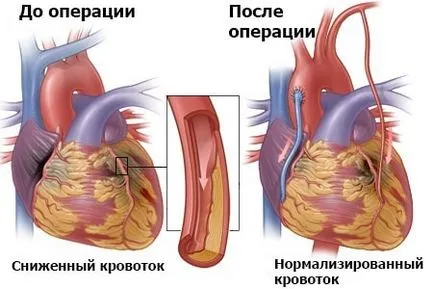 Szívkoszorúér bypass mi ez Szívkoszorúér bypass mi ez