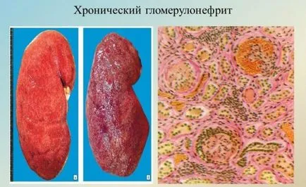 Vese kezelés gyermekeknél Vese kezelés gyermekeknél