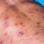 Minden kezelés ureaplasmosis