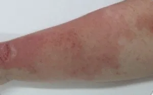 Ha megharapott egy macska Ha megharapott egy macska