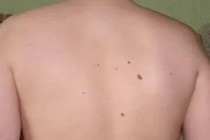 Mit csinál egy anyajegy a hátán