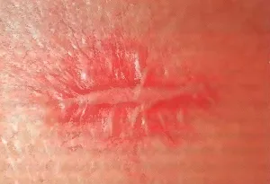 Ha megharapott egy macska Ha megharapott egy macska