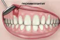 fogak Inplontanty mi ez fogak Inplontanty mi ez