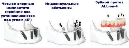 fogak Inplontanty mi ez fogak Inplontanty mi ez
