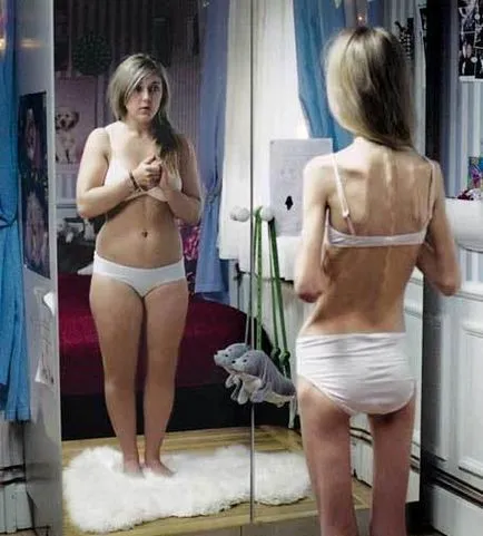 A bulimia az, ami