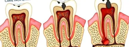 implantátum