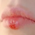 Herpes zoster kezelésére Herpes zoster kezelésére