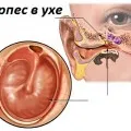 Herpes zoster kezelésére Herpes zoster kezelésére