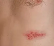 Herpes zoster kezelésére Herpes zoster kezelésére