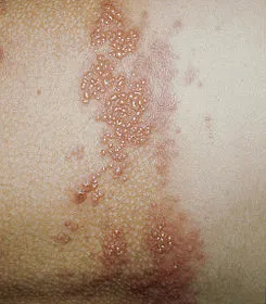 Herpes zoster kezelésére Herpes zoster kezelésére