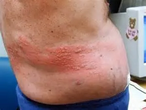Herpes zoster kezelésére Herpes zoster kezelésére