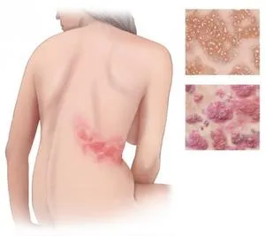 Herpes zoster kezelésére