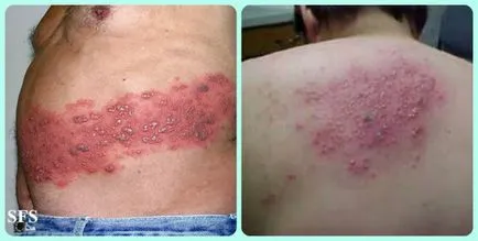 Herpes zoster kezelésére