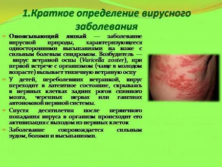 Herpes zoster kezelésére
