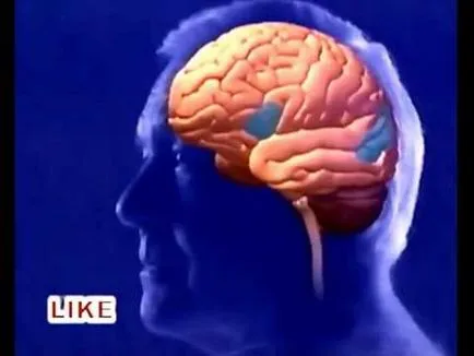Férfiakban stroke Férfiakban stroke