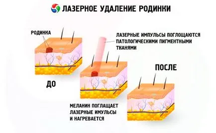 Anyajegy vérzik, hogy tegye Anyajegy vérzik, hogy tegye
