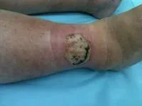 Milyen gyorsan gyógyul a seb Milyen gyorsan gyógyul a seb