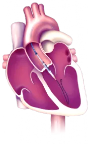 aorta tavi-val