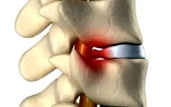 lumbosciatica