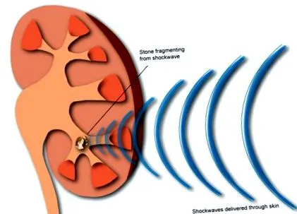 extrakorporálna litotrypsia