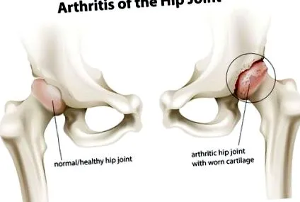 osteoarthritisére